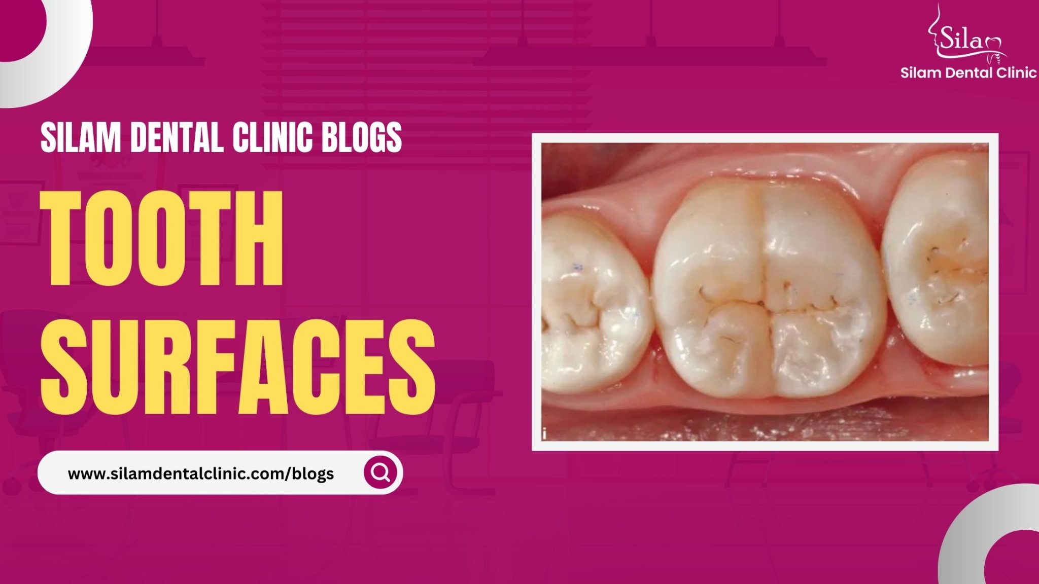 Tooth Surfaces Silam Dental Clinic